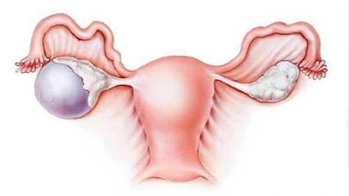 患卵巢囊肿致不孕是怎么回事？